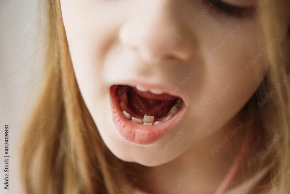 Adult permanent teeth coming in front of the child's baby teeth: shark teeth. Little girl's open mouth. Adult permanent teeth coming in front of the child's baby teeth: shark teeth. Little girl's open mouth.