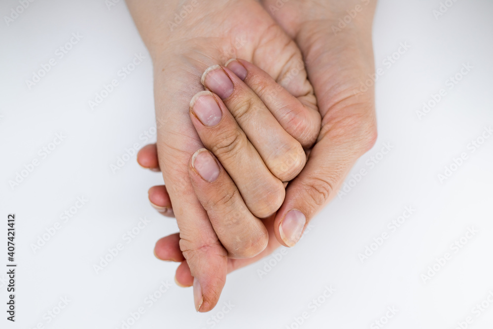 Women's hands without manicure on nails on a white background Women's hands without manicure on nails on a white background