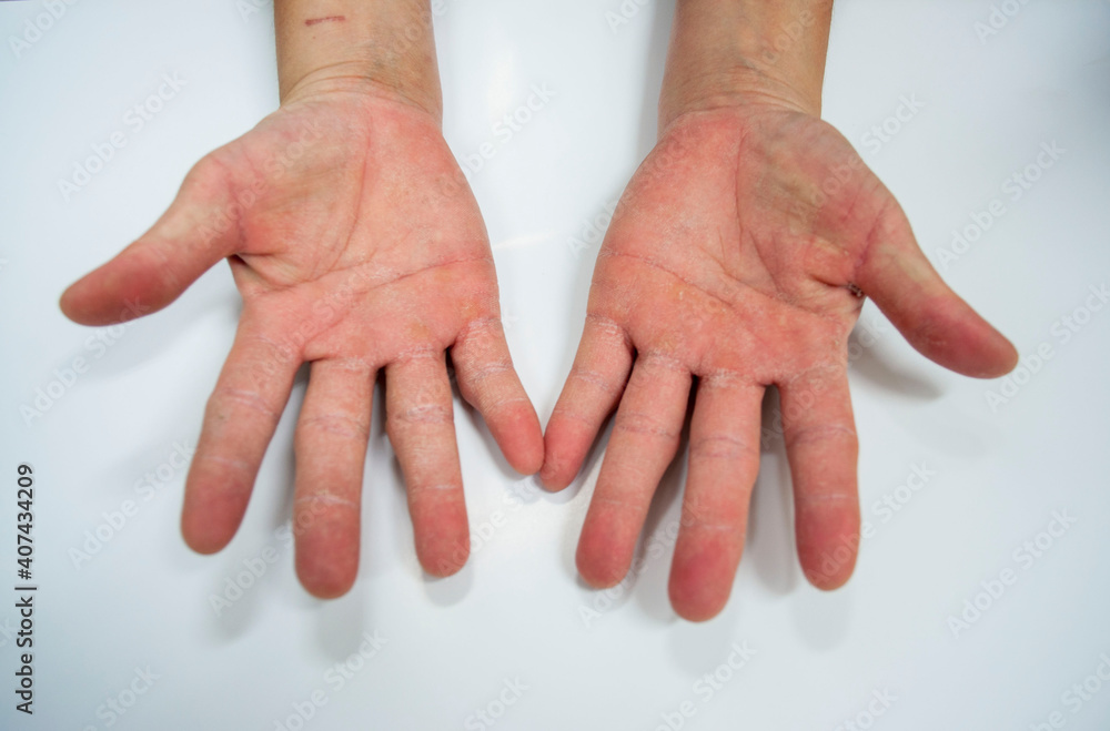 Fototapeta premium Palm of the hand with skin disease on a white background