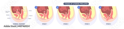 Pelvic floor prolapse type uterine uterus biofeedback pelvic floor treatment stage degree Kegel exercise surgery surgical therapy disorder cystocele urethrocele vaginal vault enterocele urethral exam