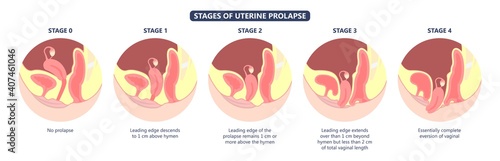 Pelvic floor prolapse type uterine uterus biofeedback pelvic floor treatment stage degree Kegel exercise surgery surgical therapy disorder cystocele urethrocele vaginal vault enterocele urethral exam