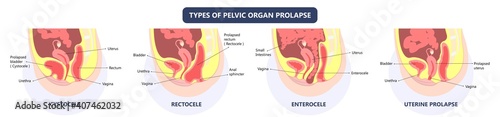 Pelvic floor prolapse type uterine uterus biofeedback pelvic floor treatment stage degree Kegel exercise surgery surgical therapy disorder cystocele urethrocele vaginal vault enterocele urethral exam