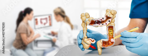 Treatment cancer colon. Doctor pointing pen tumor intestines using an anatomical model. Consultation gastroenterologist for a patient over background photo