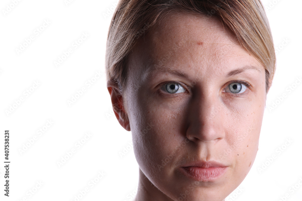 Combination skin problems, dry and oil parts, comedones, wide pores on face