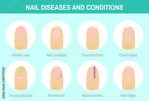 Vector illustration "Nail diseases and conditions". 8 circle images set. Female fingernail with or without different disorders. Colorful infographic for medical articles, posters and banners.