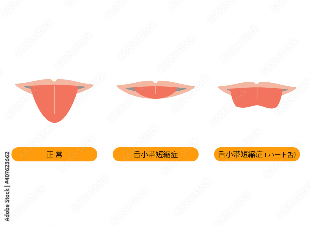 正常な舌と、舌小帯短縮症で伸ばせない舌のイラスト vector de Stock | Adobe Stock