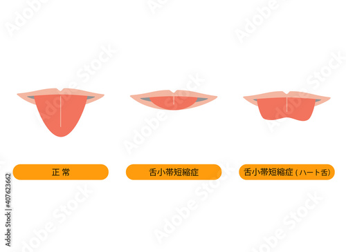 正常な舌と、舌小帯短縮症で伸ばせない舌のイラスト