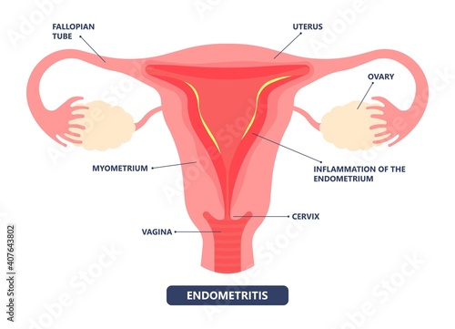 Cancer pelvic PCOS ovary Endo belly pain swelling uterus heavy ovaries cysts examine surgery remove pregnancy endobelly tube cycle period Fertility problem diagnosis menstruation cell polyp cervical