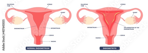 Cancer pelvic PCOS ovary Endo belly pain swelling uterus heavy ovaries cysts examine surgery remove pregnancy endobelly tube cycle period Fertility problem diagnosis menstruation cell polyp cervical