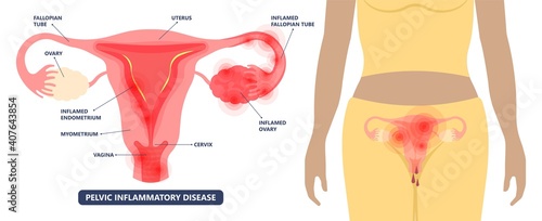 Cancer pelvic PCOS ovary Endo belly pain swelling uterus heavy ovaries cysts examine surgery remove pregnancy endobelly tube cycle period Fertility problem diagnosis menstruation cell polyp cervical