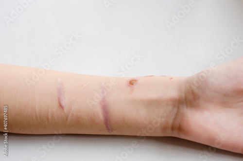 Scars on the arm, close-up.