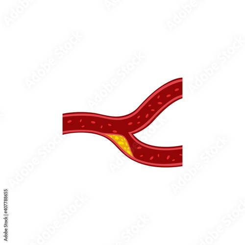 vector of cholesterol plaque illustratrion