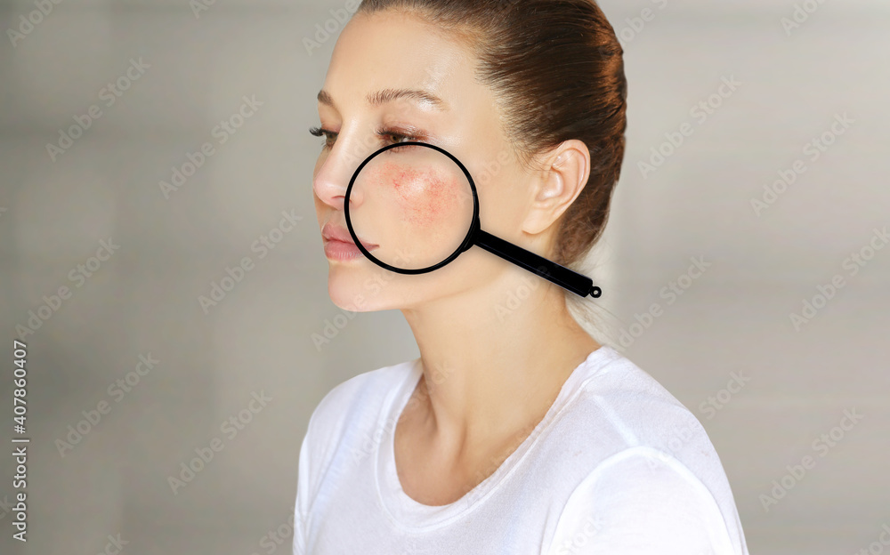 Rosacea,reducing the redness of enlarged blood vessels. Rosacea,reducing the redness of enlarged blood vessels.