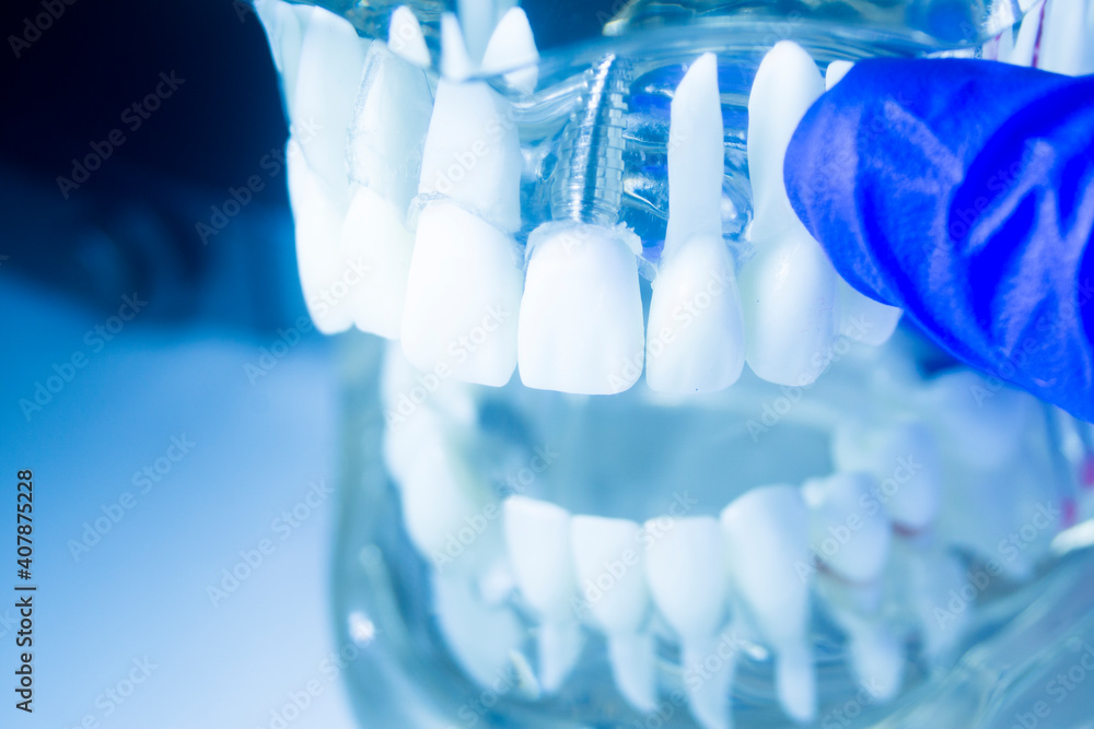 Dental tooth implant model Dental tooth implant model