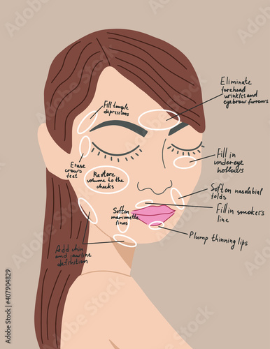 areas for face fillers. girl on a beige background. injection zones.