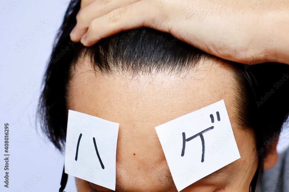 おでこが広い男性 ハゲ Stock Photo Adobe Stock