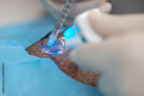 Billede på lærred Hair Implantation process, Injecting Anestesia in Scalp
