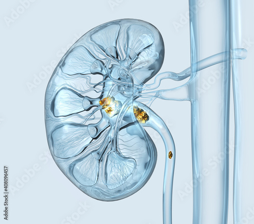 Kidney stones in minor and major calyces and ureter, medically 3D illustration photo