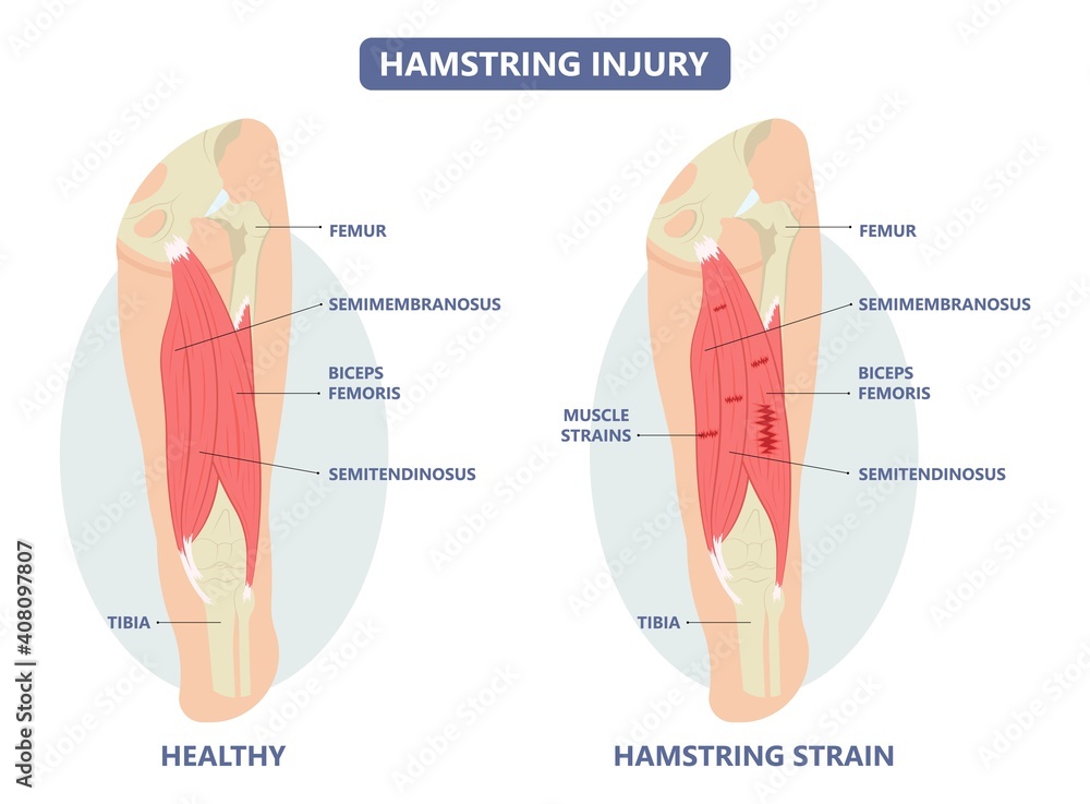 muscle leg knee biceps hip pulled tear injury grade pain running thigh  examine cramp soccer football