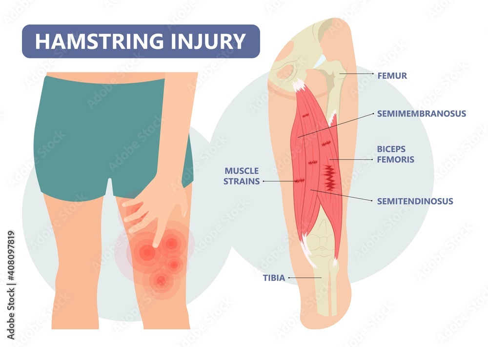 Vecteur Stock muscle leg knee biceps hip pulled tear injury grade