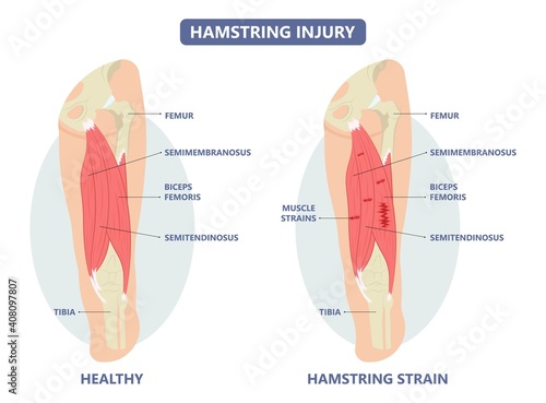 muscle leg knee biceps hip pulled tear injury grade pain running thigh examine cramp soccer football lacrosse pull sport athlete RICE torn skater player treat IT band first aid stretching back pelvis