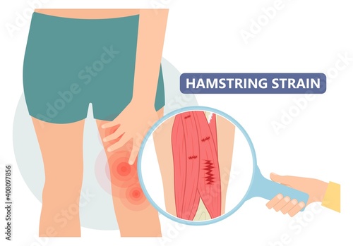 muscle leg knee biceps hip pulled tear injury grade pain running thigh examine cramp soccer football lacrosse pull sport athlete RICE torn skater player treat IT band first aid stretching back pelvis