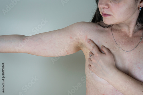 Women with symptoms of itchy urticaria or allergic reaction on the skin. Red rash on the females body. Concepts of allergy  skin diseases and health care.