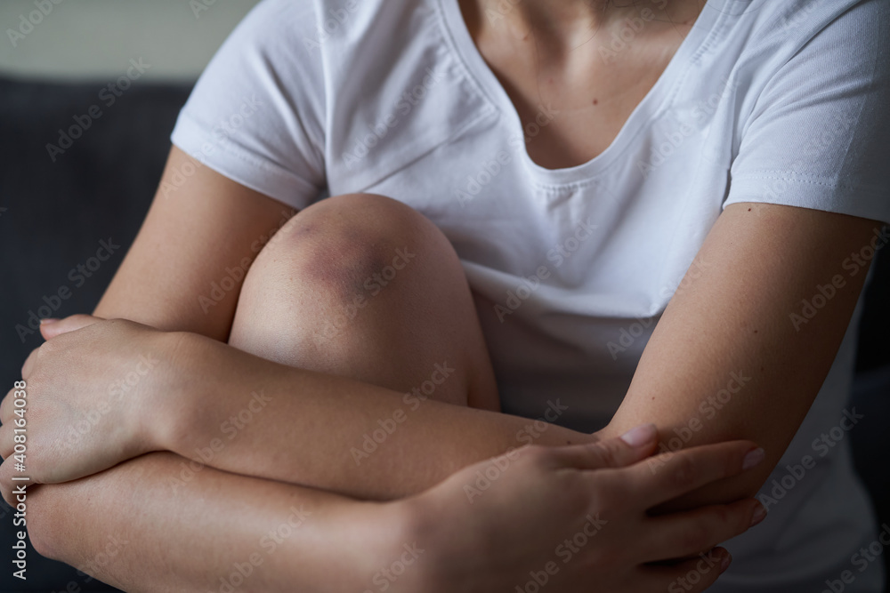 Close-up of a person massaging an injured knee joint. Bruise on the knee. Leg pain Close-up of a person massaging an injured knee joint. Bruise on the knee. Leg pain