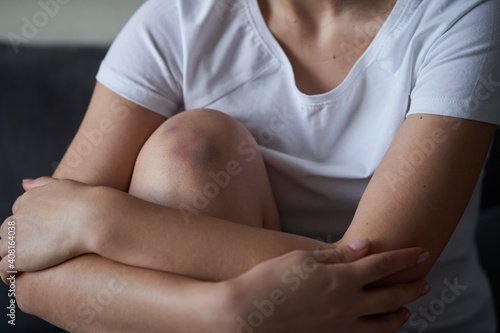 Close-up of a person massaging an injured knee joint. Bruise on the knee. Leg pain