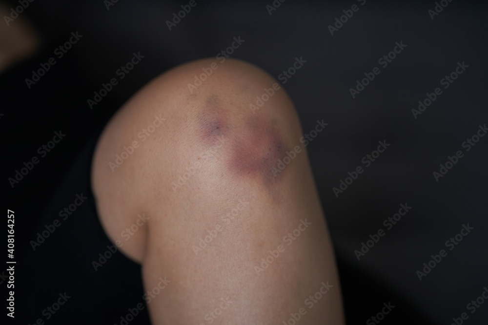Close-up of a person massaging an injured knee joint. Bruise on the knee. Leg pain Close-up of a person massaging an injured knee joint. Bruise on the knee. Leg pain