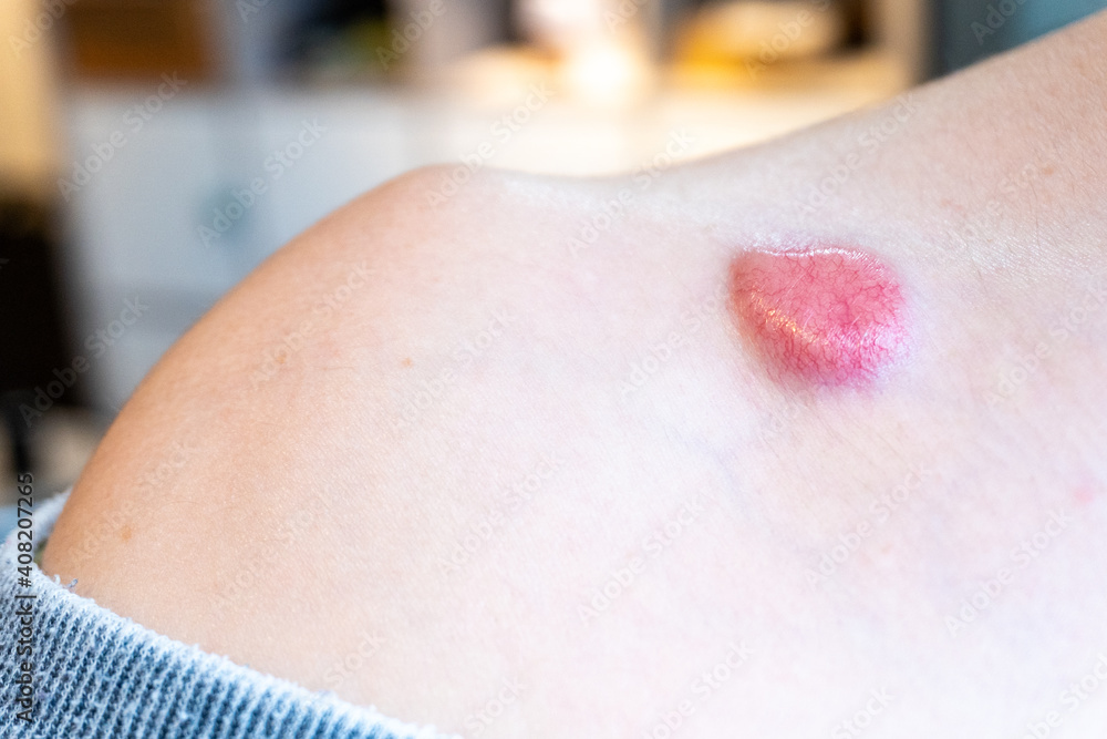 Fototapeta premium Raised dermatfibrosarcoma protuberans (DFSP, non-melanoma skin cancer) on chest shoulder having formed red pigment and spider veins, removable by mohs surgery