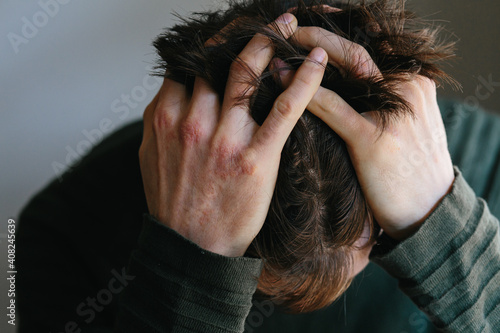 Young man put hands with psoriasis or eczema to his head. He feeling sick. Male expression concept.