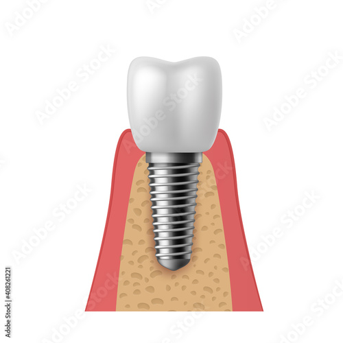 Realistic tooth implant. 3D denture orthodontic implantation teeth, implant structure pictorial models crown. Prosthetics in stomatology clinic concept vector isolated illustration