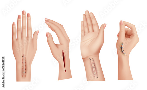 Surgical stitches on hands. Closeup scars and wounds on human hand medical damaged skin decent vector realistic templates. Surgical medical operation, surgeon stitch illustration