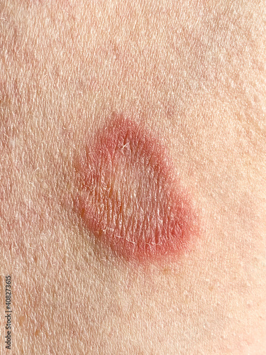 Ringworm infection on the arm af a caucasian adult male photo