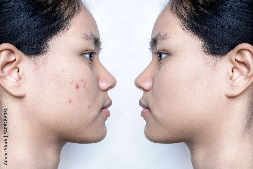 Young Asian woman face before and after acne treatment on white background. Skincare concept Young Asian woman face before and after acne treatment on white background. Skincare concept