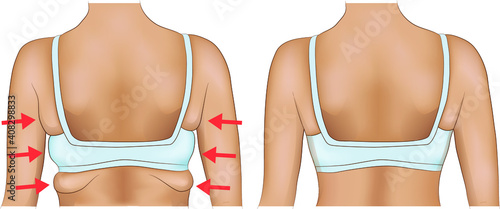 Armpits fat of a woman with arrow designation. Armpits fat before and after diet or surgery