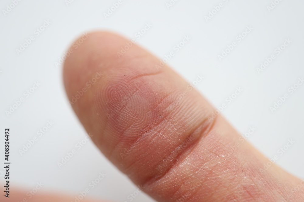 On finger there is red callus and an abscess On finger there is red callus and an abscess