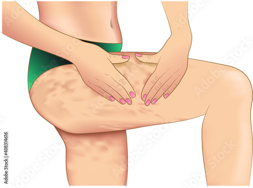 Woman shows cellulite on her leg