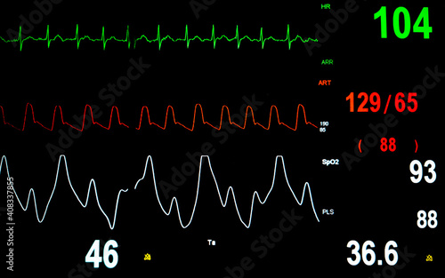 Patient vital sign monitor display in the intensive care unit.
