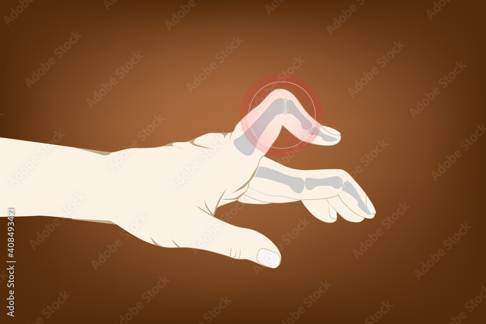 Trigger finger or finger lock is a condition in which one of your