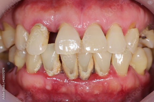 Periodontitis is often known as 'Gum Disease' and is a very common condition in which the gums and deeper periodontal structures become inflamed. photo