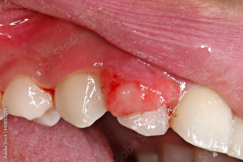 Fotografie The pyogenic granuloma is a relatively common, tumorlike, exuberant tissue response to localized irritation or trauma