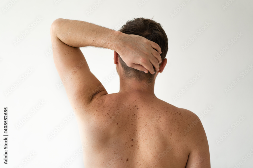 Checking benign moles. Close up detail of the bare skin on a man back with scattered moles and freckles