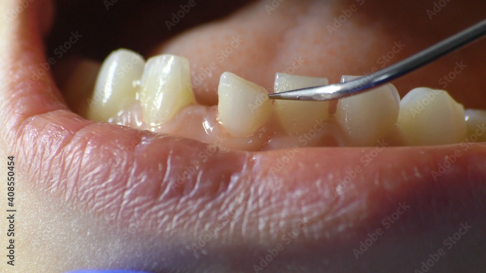 Obraz premium Dentist Inspecting Loose Tooth with Dental Probe