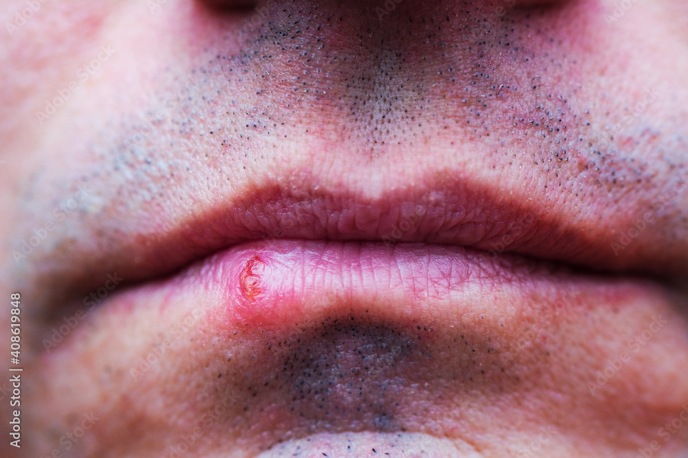 Fototapeta premium Herpes virus infection in man lips. Problem health care. Dermatological oral skin diseases.