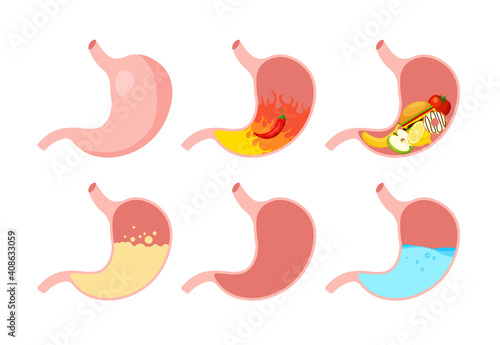 Healthy and unhealthy, empty and full human stomach in trendy flat style. Nutrition, stomach pain, bloating. Digestive system anatomy. Vector illustration isolated on white background.