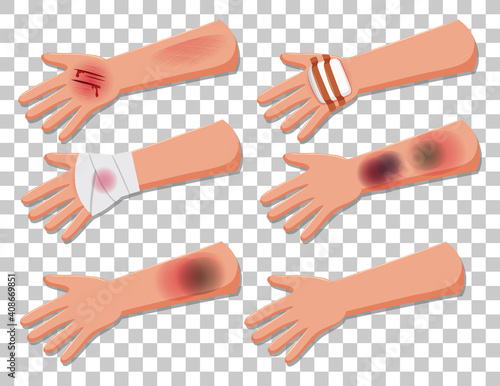Set of injury arms on transparent background