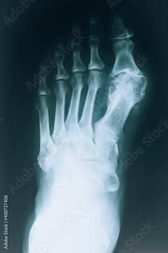 X-ray of the foot. Human foot bones close up