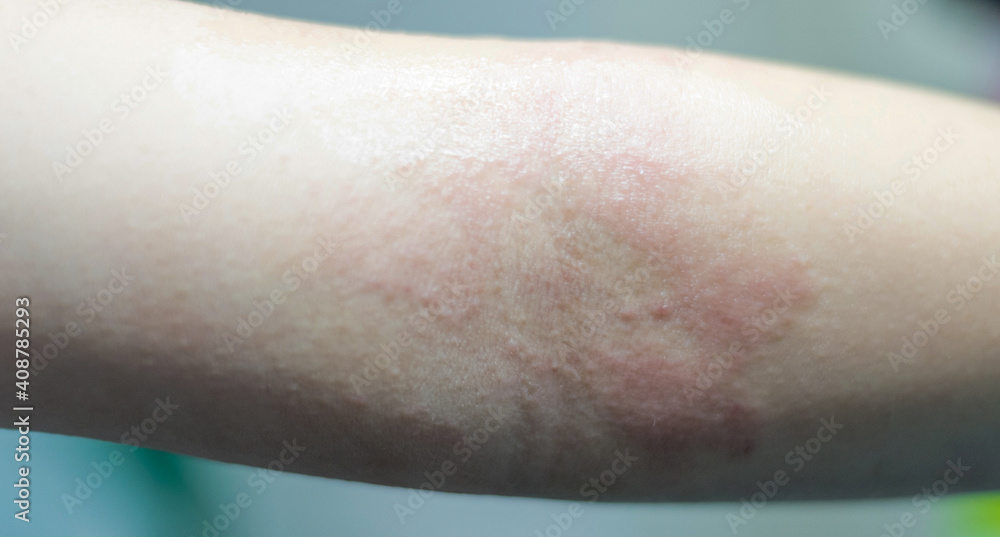 eczema atopic dermatitis symptom with infected skin on child foldable